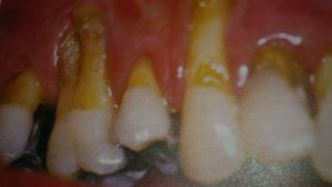 periodontitis cronica